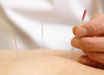 Patient receiving acupunction treatment